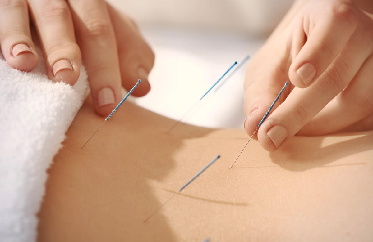Naturheilverfahren Akupunktur