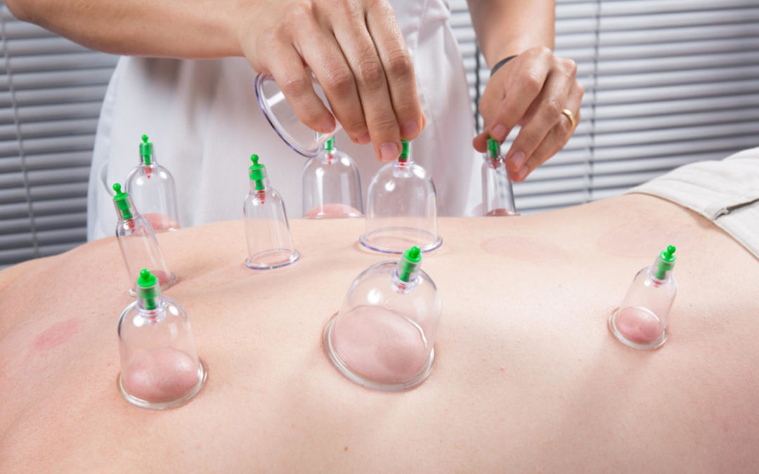 Schröpfmassage für intensive Durchblutungsförderung